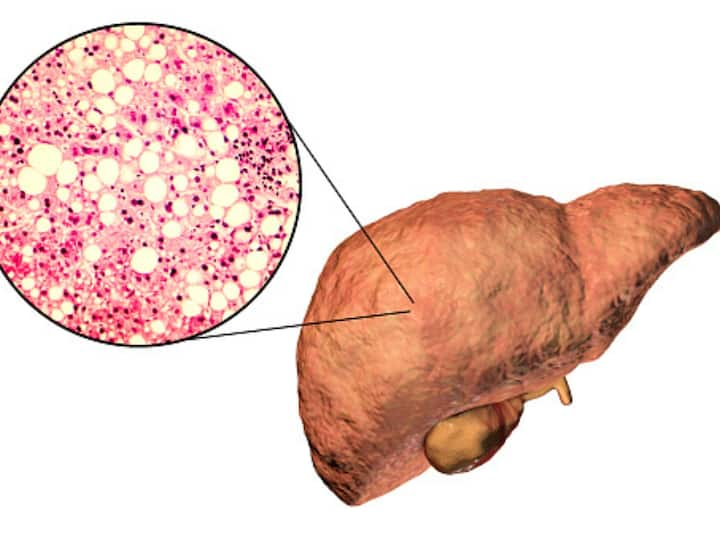 ప్రపంచ కాలేయ దినోత్సవం 2023 ఫ్యాటీ లివర్ డిసీజ్ నాన్ ఆల్కహాలిక్ నాన్ స్టీటోహెపటైటిస్‌కు నివారణ నిపుణులు ఏమి చెబుతున్నారో తెలుసుకోండి